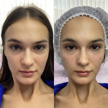 Центелла мезотерапія
                    Косметологический центр  Ужгород