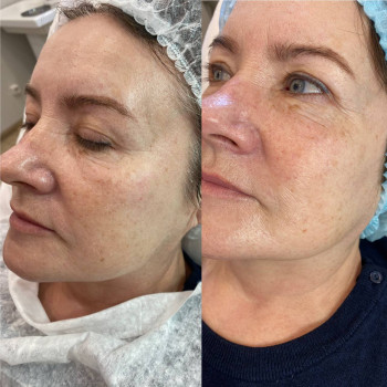 Центелла мезотерапія
                    Косметологический центр  Ужгород