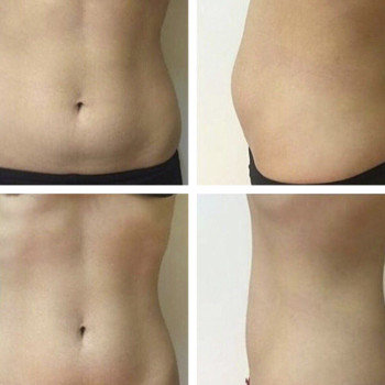 L-carnitin мезотерапія
                    Косметологический центр  Ужгород