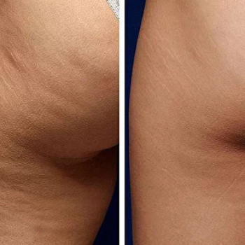 L-carnitin мезотерапія
                    Косметологический центр  Ужгород