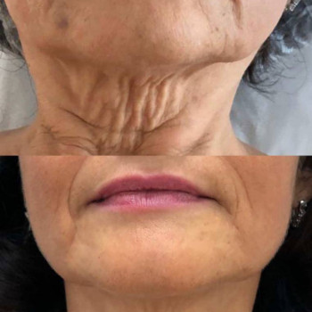 Мікроголковий РФ ліфтинг обличчя+шия
                    Косметологический центр  Ужгород