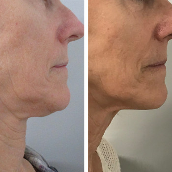 Мікроголковий РФ ліфтинг обличчя+шия
                    Косметологический центр  Ужгород