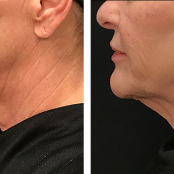 Мікроголковий РФ ліфтинг обличчя+шия
                    Косметологический центр  Ужгород