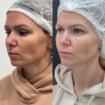 Мікроголковий РФ ліфтинг обличчя+шия
                    Косметологический центр  Ужгород