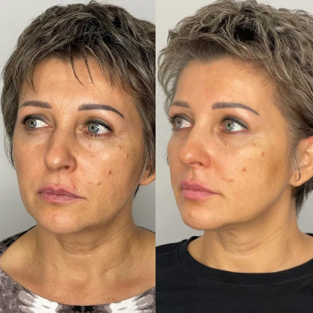 Мікроголковий РФ ліфтинг обличчя+шия
                    Косметологический центр  Ужгород