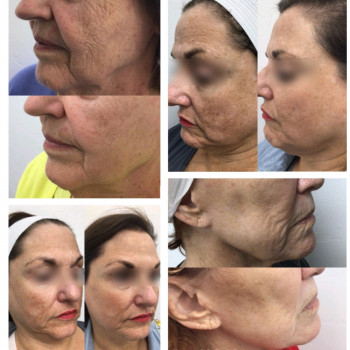 Мікроголковий РФ ліфтинг обличчя+шия
                    Косметологический центр  Ужгород