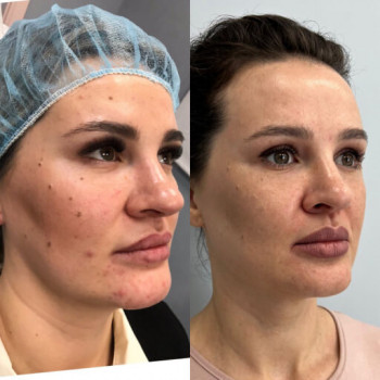 Мікроголковий РФ ліфтинг обличчя+шия+декольте
                    Косметологический центр  Ужгород