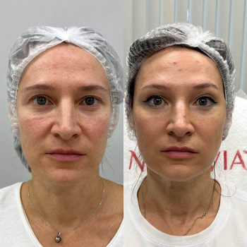 Мікроголковий РФ ліфтинг обличчя+шия+декольте
                    Косметологический центр  Ужгород