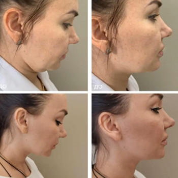 Мікроголковий РФ ліфтинг обличчя+шия+декольте
                    Косметологический центр  Ужгород