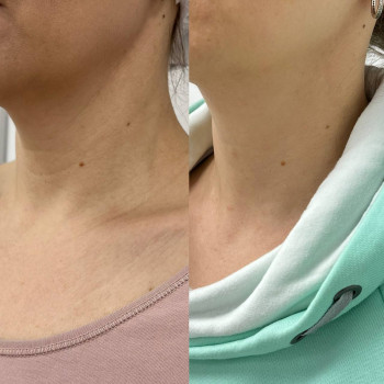 Мікроголковий РФ ліфтинг шия+декольте
                    Косметологічний центр  Ужгород