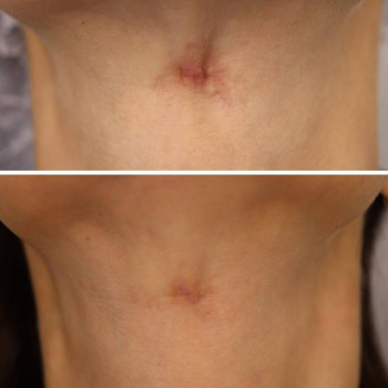 Мікроголковий РФ ліфтинг шия+декольте
                    Косметологічний центр  Ужгород