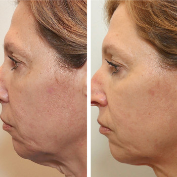 Мікроголковий РФ ліфтинг шия+декольте
                    Косметологічний центр  Ужгород