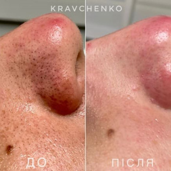Чистка обличчя
                    Лікар-косметолог Филипп Київ