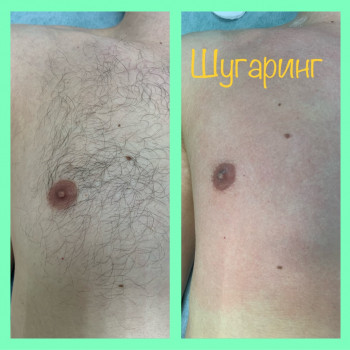 Шугарінг чоловічих грудей