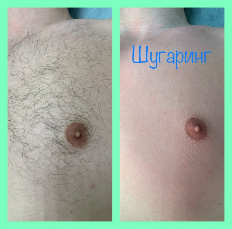 Шугарінг чоловічого торса, фото - Мастер по пирсингу Татьяна Ананьева