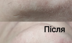 Електроепіляція обличчя Косметолог Юлия Київ