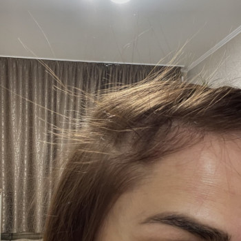 Ефект від мезотерапії волосся. 4 працедури