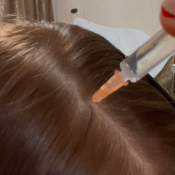 Мезотерапія шкіри голови стимулює кровообіг, покращує живлення волосяних фолікулів і запобігає випад...