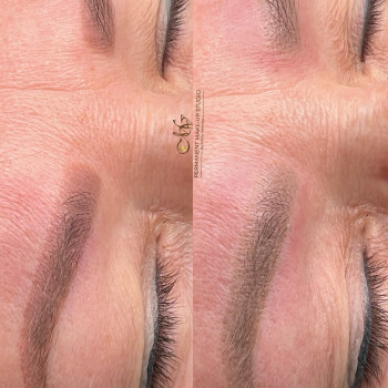 1 процедура видалення неодимовим лазером