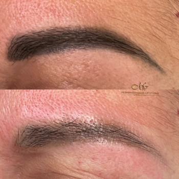 Лазер+ремувер