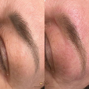 1 лазерне видалення