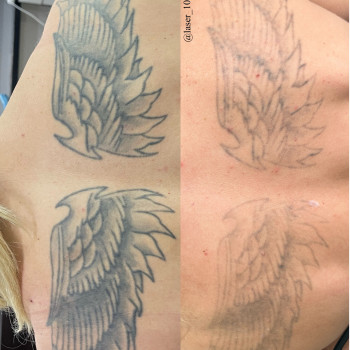 6 лазерних видалень