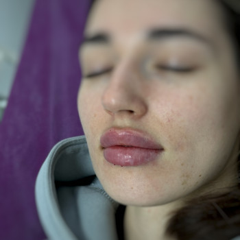 Збільшення губ
                    Косметолог-ін'єкціоніст Анна Чернівці