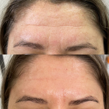 Ботулінотерапія
                    Косметолог-инъекционист Анна Черновцы