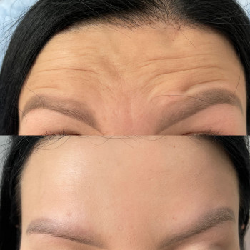 Ботулінотерапія
                    Косметолог-инъекционист Анна Черновцы