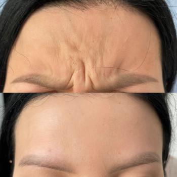 Ботулінотерапія
                    Косметолог-инъекционист Анна Черновцы