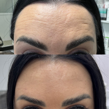 Ботулінотерапія
                    Косметолог-инъекционист Анна Черновцы