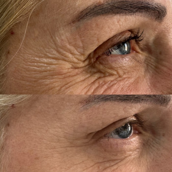 Ботулінотерапія
                    Косметолог-инъекционист Анна Черновцы