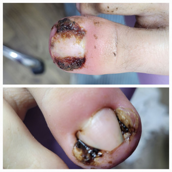 Лікування врослого нігтя.
Лікування запалення при врослому нігті.
Видалення врослого нігтя