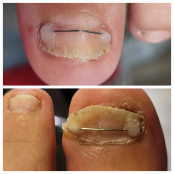 Титанова нитка