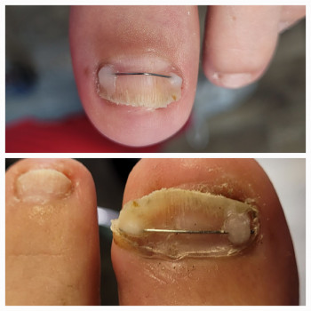 Корекція нігтя на нозі. Корекція нігтьової пластини за допомогою титанової нитки.