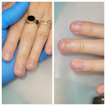 Лікування нігтів на руках.
Опіки нігтьової пластини.
Онихолізіс.