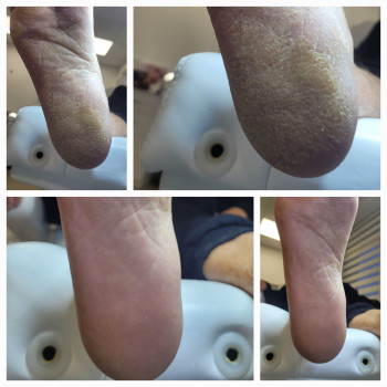 Лікування шкіри стоп.
Чоловічий педікюр
Зачистка п'ят.