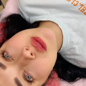 Контурна пластика губ