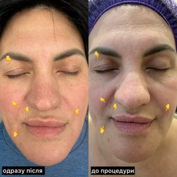 Результат одної процедури Мікроголкового РФ