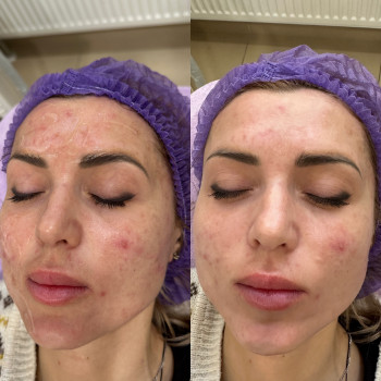 Результат одною процедури IPL терапії - лікування акне