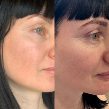 Результат одної процедури IPL - лікування пігментації