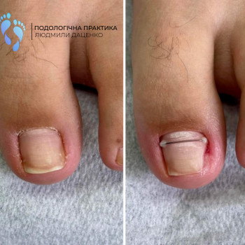 Встановлення корекційної системи
                    Подолог Людмила Черкассы