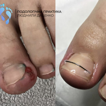 Встановлення корекційної системи
                    Подолог Людмила Черкассы