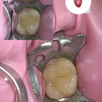 Лікування карієсу