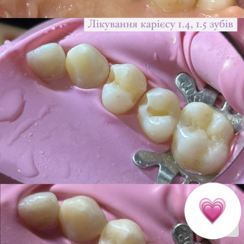 Лікування карієсу