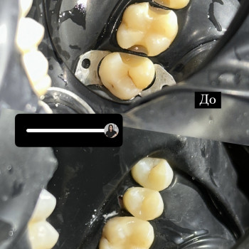 Лікування карієсу