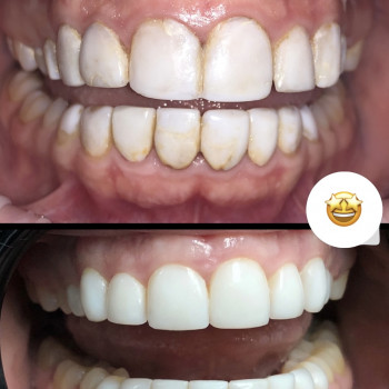 Заміна композитних вінірів 10 верхніх і 10 нижніх зубів