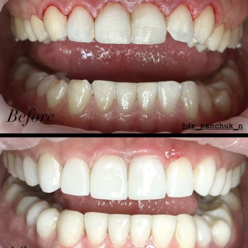 Композитні вініри 10 верхніх і 8 нижніх зубів