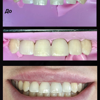 Художня реставрація 4 зубів