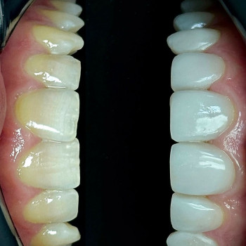 Композитні вініри 10 верхніх зубів і 8 нижніх